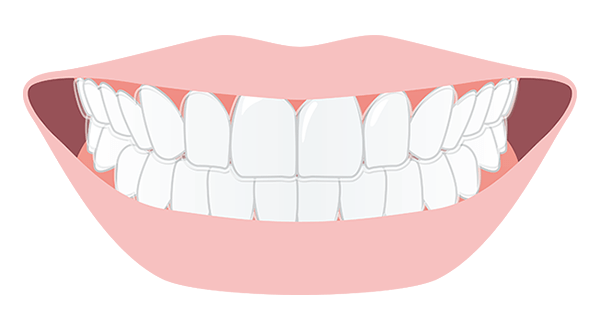 インビザライン