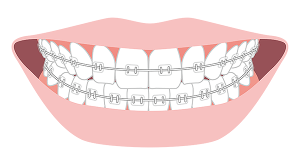 表側矯正(ワイヤー矯正)
