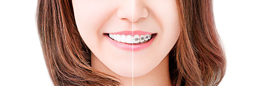 インビザラインと他の矯正装置の比較